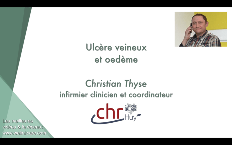 Ulcère veineux et oedème (Christian Thyse)