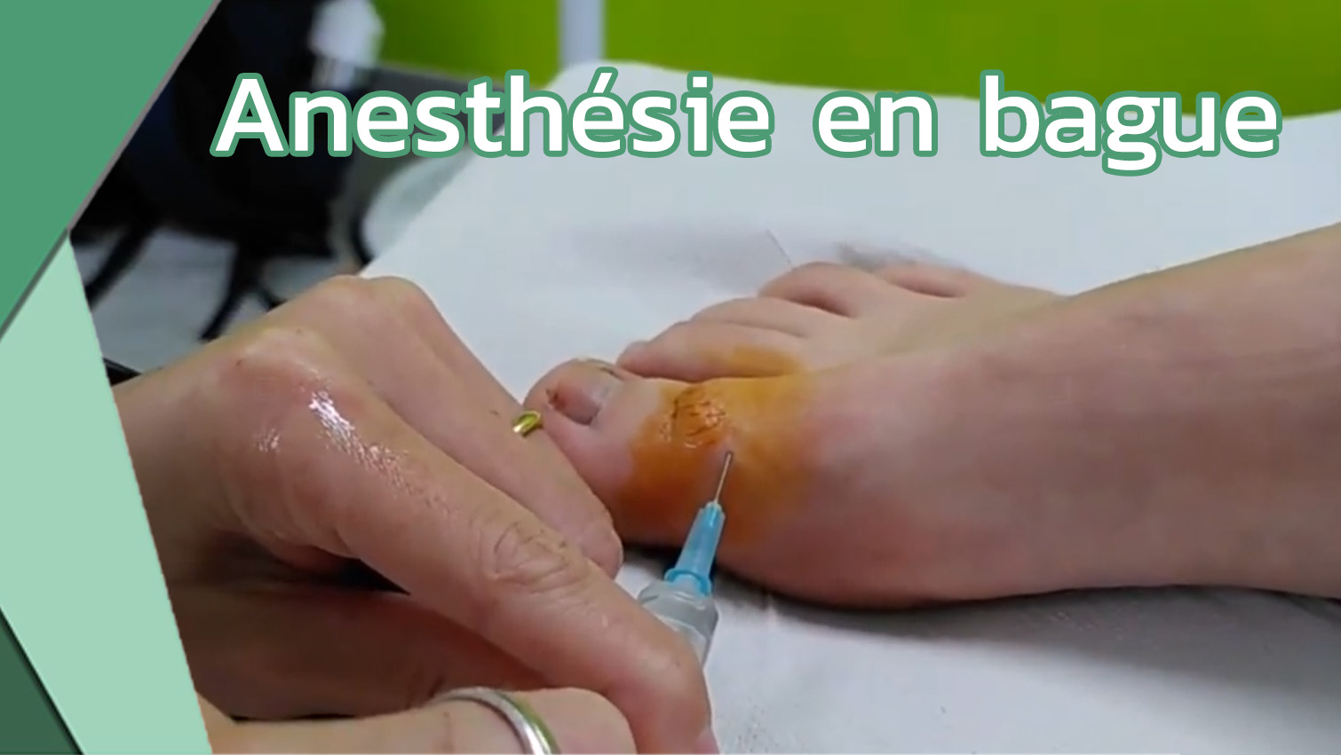 Anesthésie en bague (Dr Mathilde Lechat)