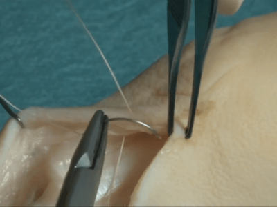 La suture cutanée (Marc Revol)