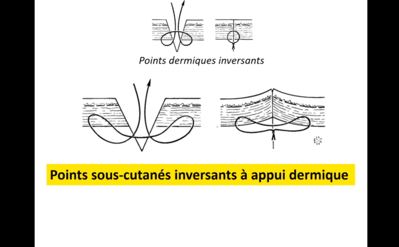 La suture cutanée sous tension (Marc Revol)