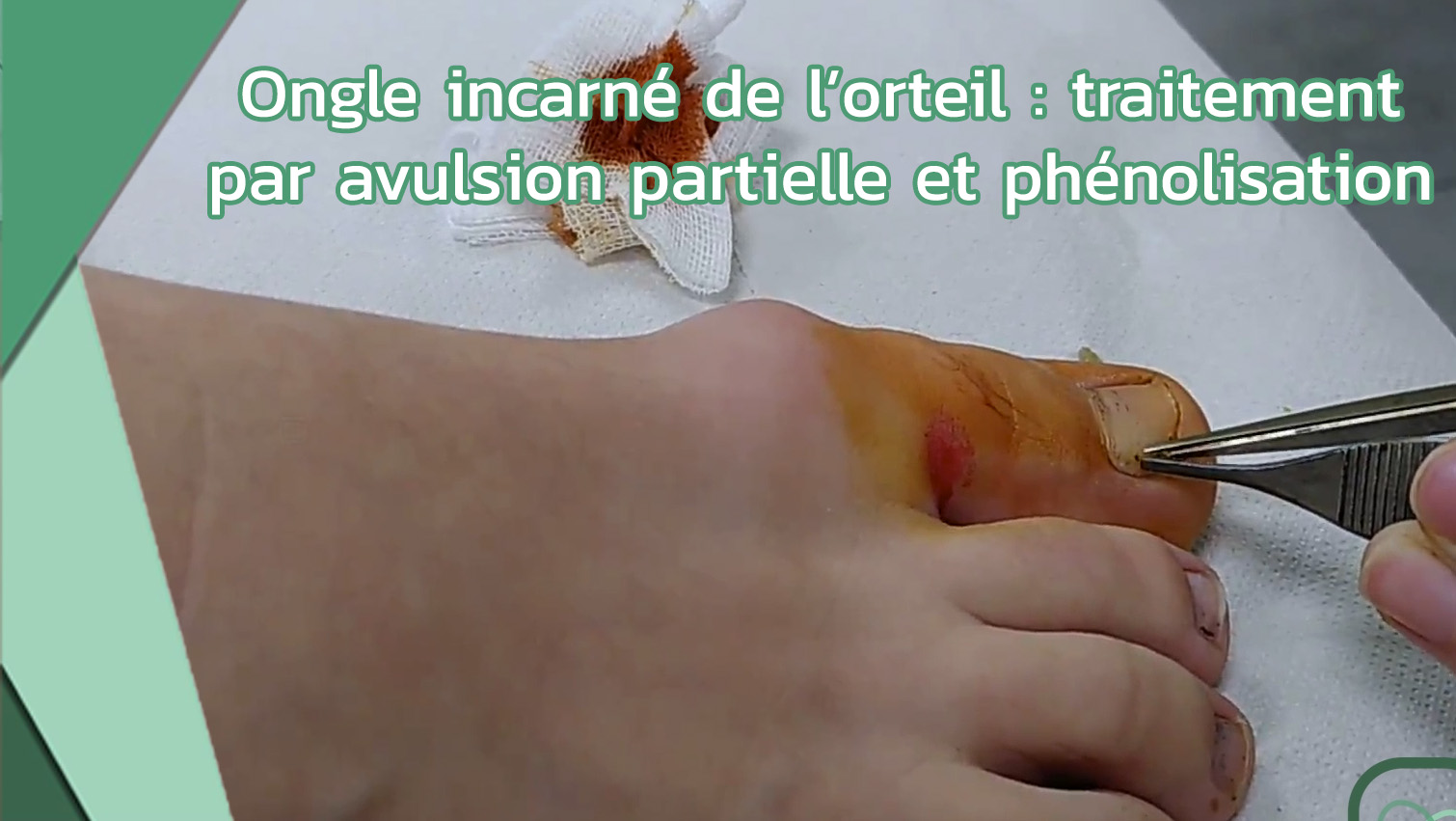 Ongle incarné de l’orteil traitement par avulsion partielle et phénolisation (Dr Mathilde Lechat)