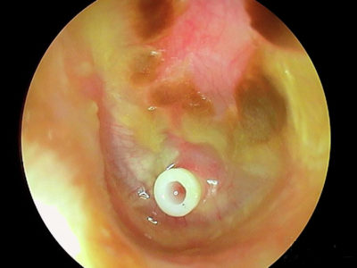 Infections ORL pédiatriques, 1e partie: infections de l'oreille