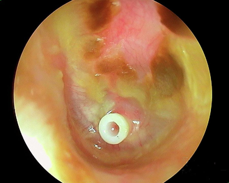 Infections ORL pédiatriques, 1e partie: infections de l'oreille