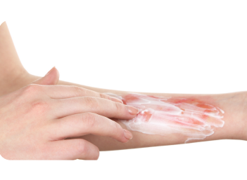 Les brûlures de la peau sont classées par degré en fonction de la gravité des lésions cutanées